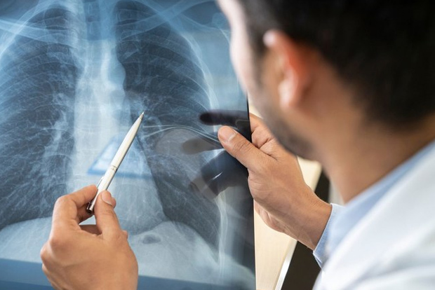 Researchers develop AI to detect Covid on chest x-rays