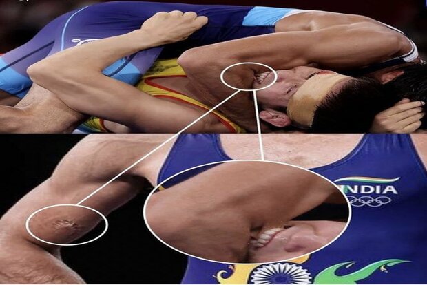 Repeatedly Bitten By Opponent, But Wrestler Dahiya Emerged On Top