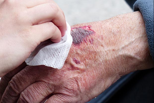 Study explores how immune cells are controlled during wound healing