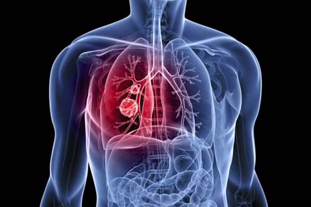 Cells damaged by chronic lung disease can result in severe Covid
