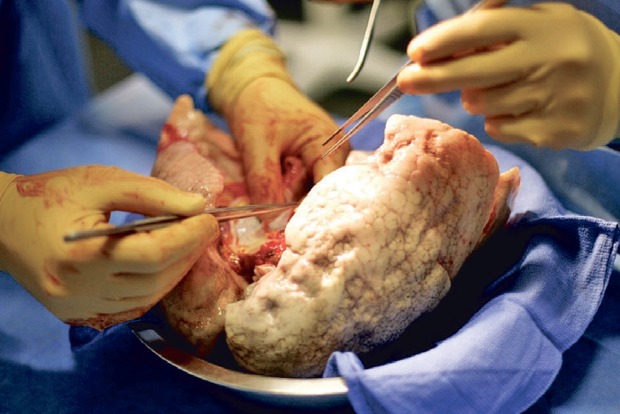 Need for dual lung transplants goes up in post-COVID patients in Chennai