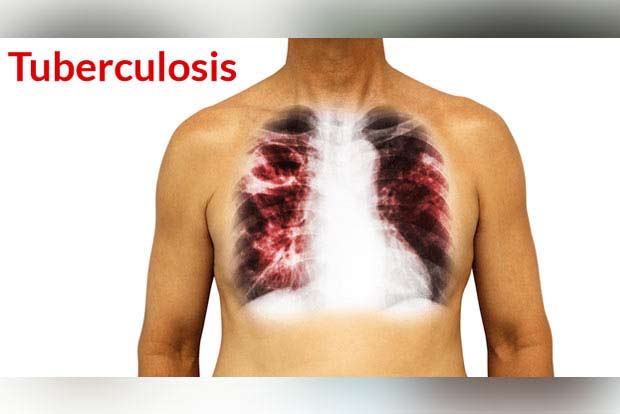 Covid can activate dormant bacterial infection, TB: Study