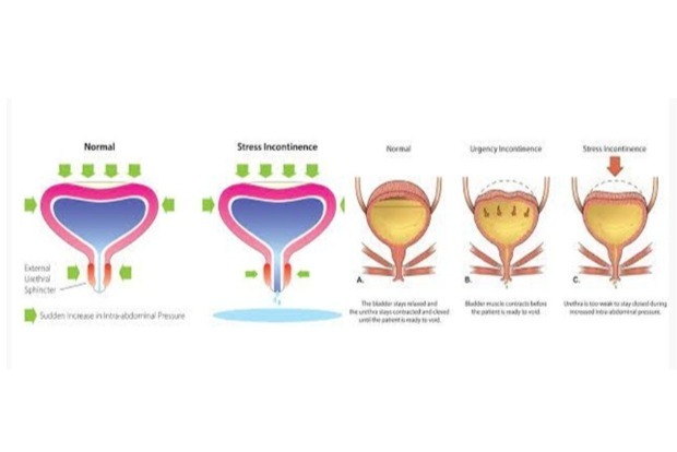 Urinary Incontinence