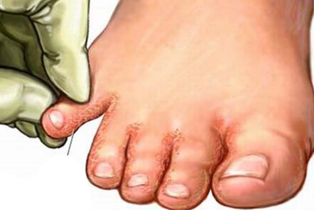 Explained: What causes Covid toe condition
