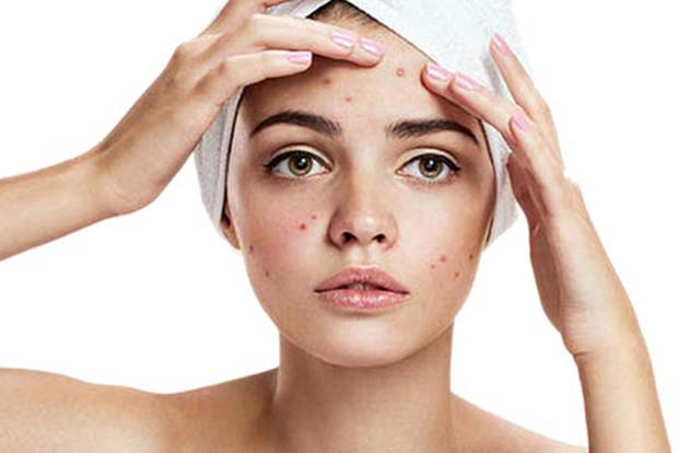 Heres how you deal with winter acne breakouts Heres how you deal with winter acne breakouts