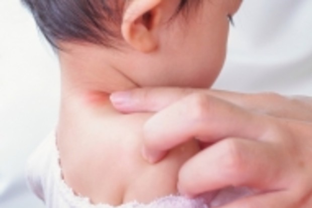 5 ways to manage childhood allergies