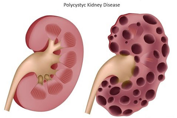 Kidney disorder is not end of the road