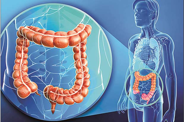 ‘Colorectal cancer cases on the rise’