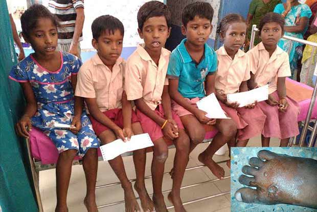 Primary school teacher brands 11 students with hot camphor