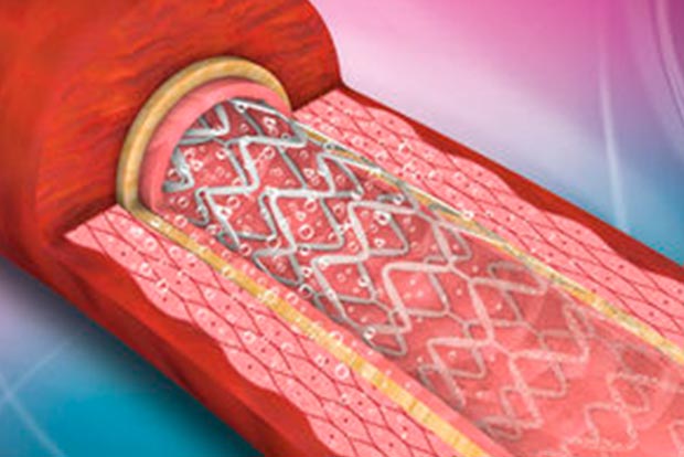 Made in India new generation heart stent receives major global recognition Made in India new generation heart stent receives major global recognition